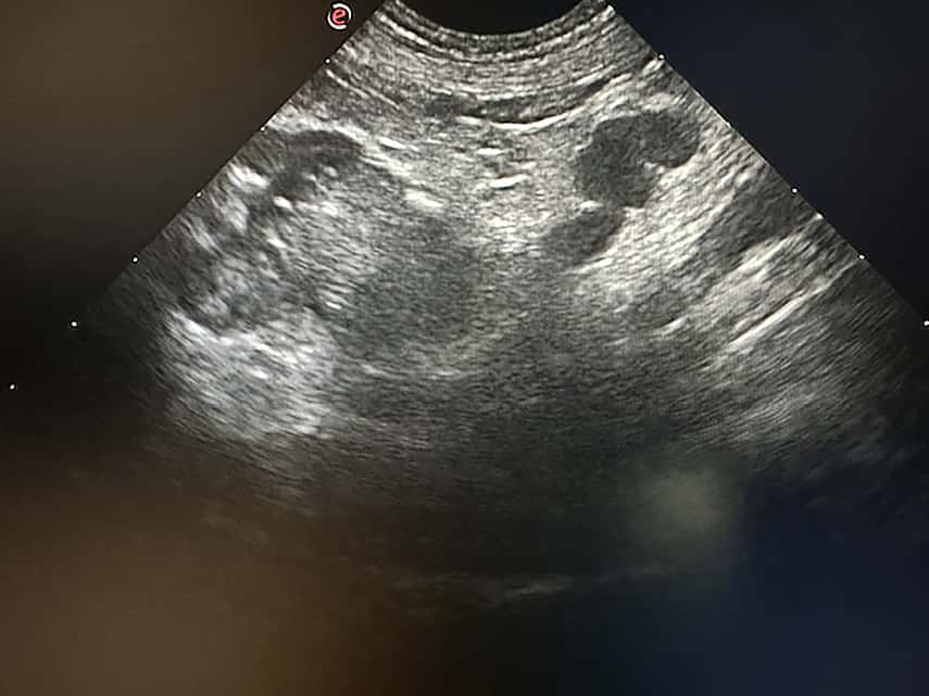 Septische peritonitis