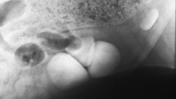 Gros plan d’une radiographie.