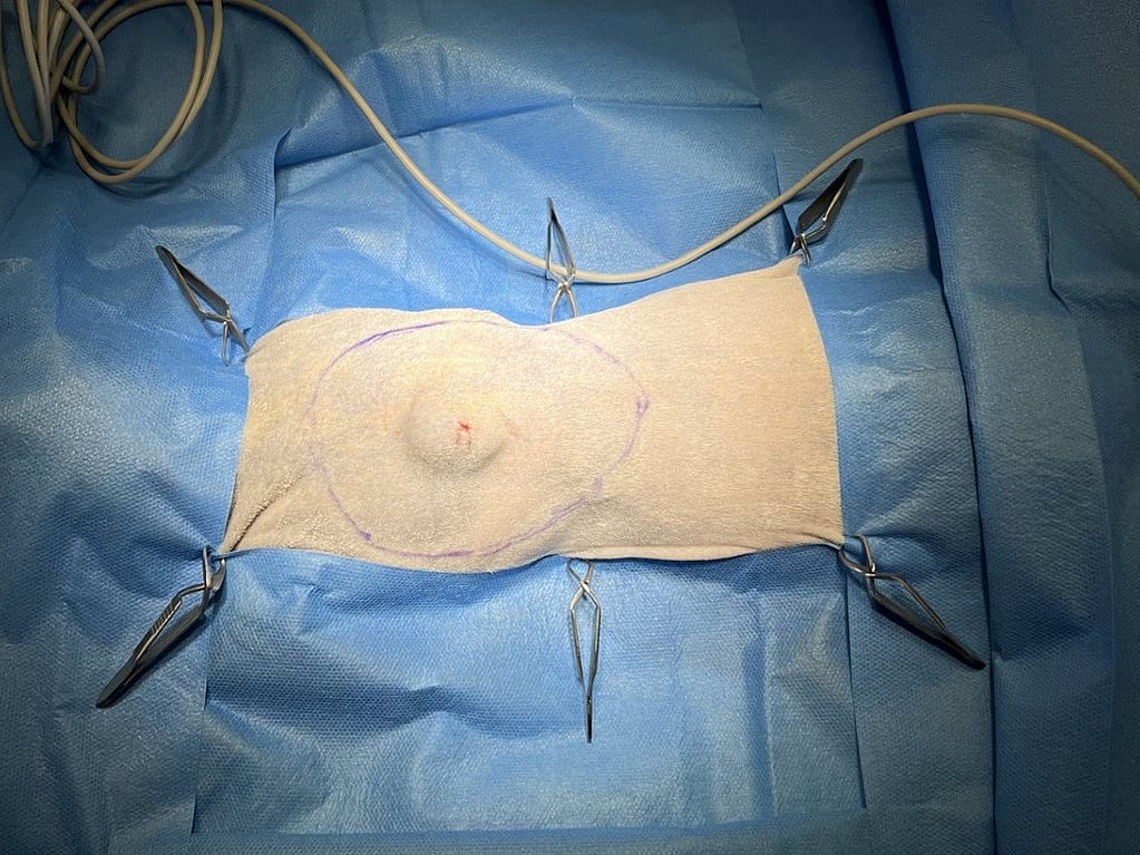 Een chirurgisch materiaal met een cirkel erop getekend.
