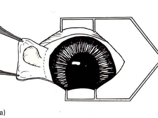 Un dessin d’un globe oculaire.