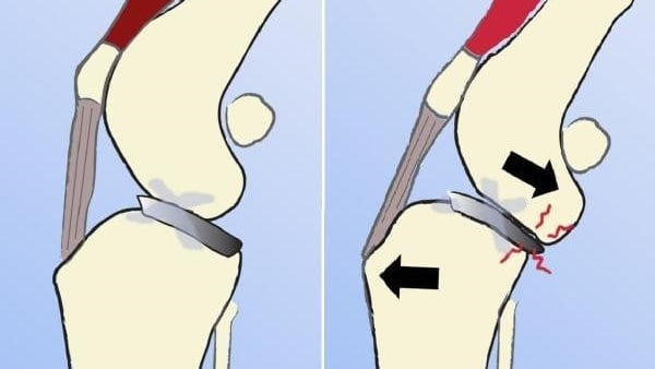 Une comparaison d’une articulation du genou.