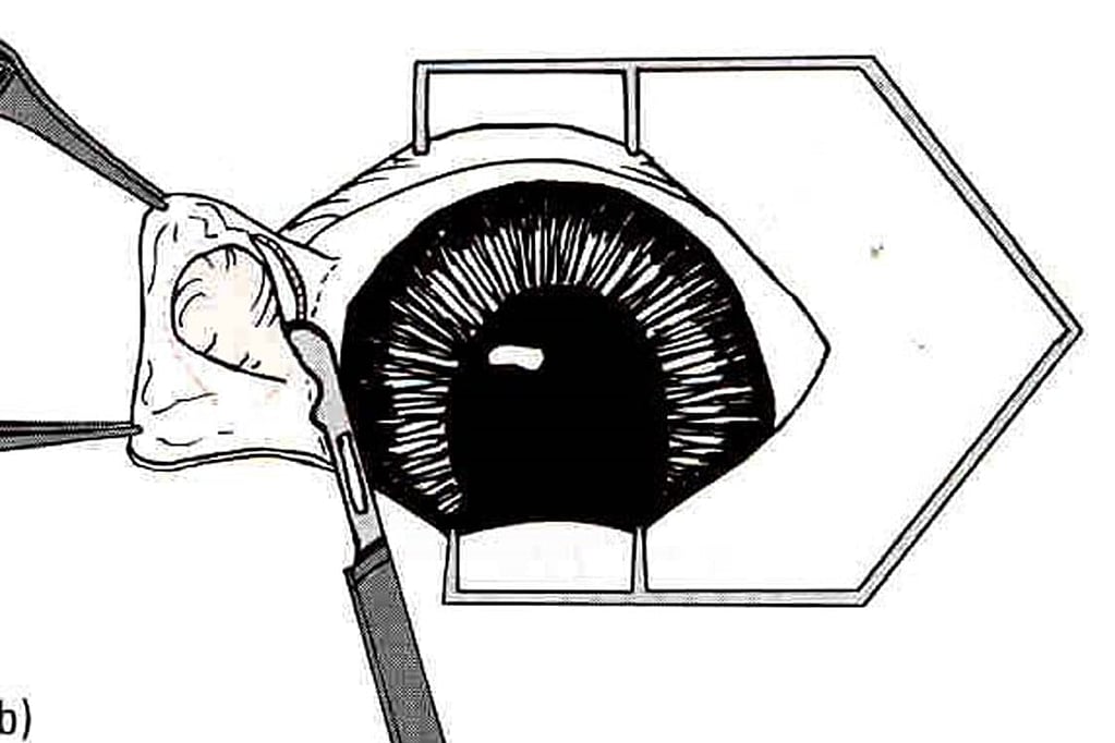 Een tekening van een oog met een scalpel.