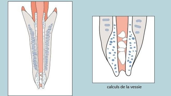 Un schéma de la dent et de la dent veineuse.