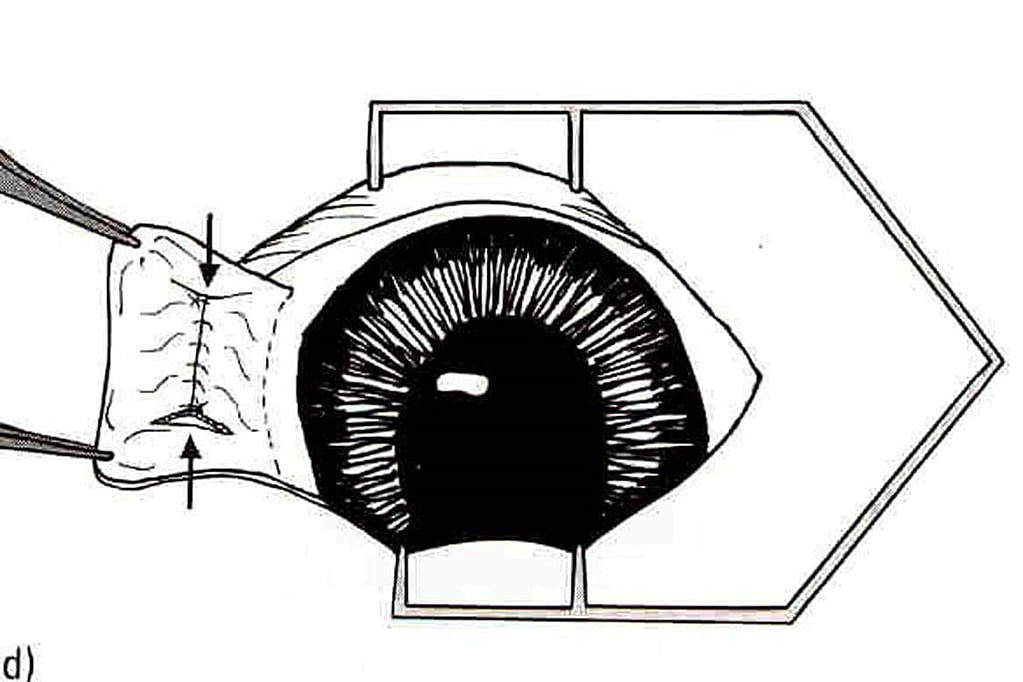 Een diagram van een oogbol.