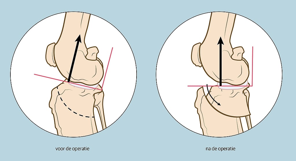 Een diagram van een kniegewricht.