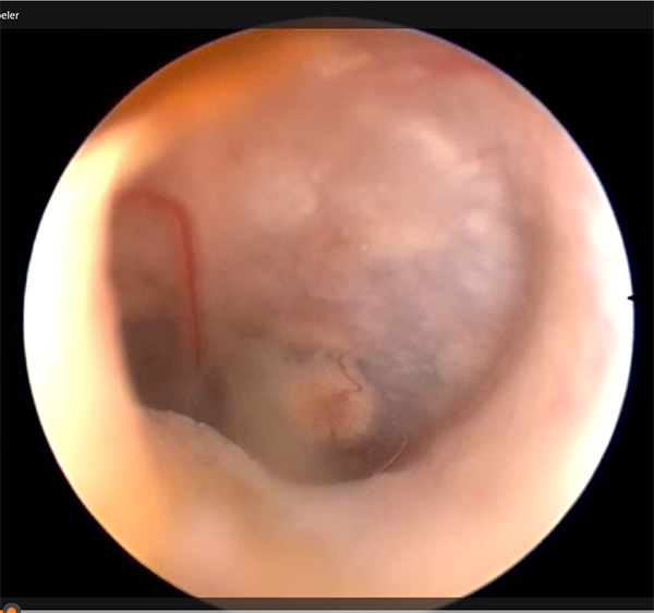 Otitis medi
