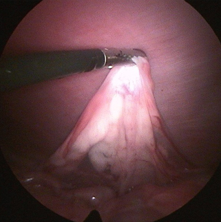 Een close-up van een chirurgisch instrument.